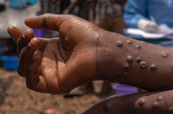 Health Alert!: Ghana Records New Cases of Mpox May 16, 2025