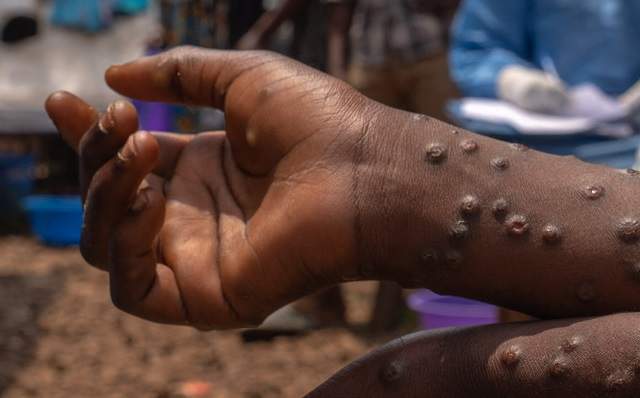 Health Alert!: Ghana Records New Cases of Mpox May 16, 2025